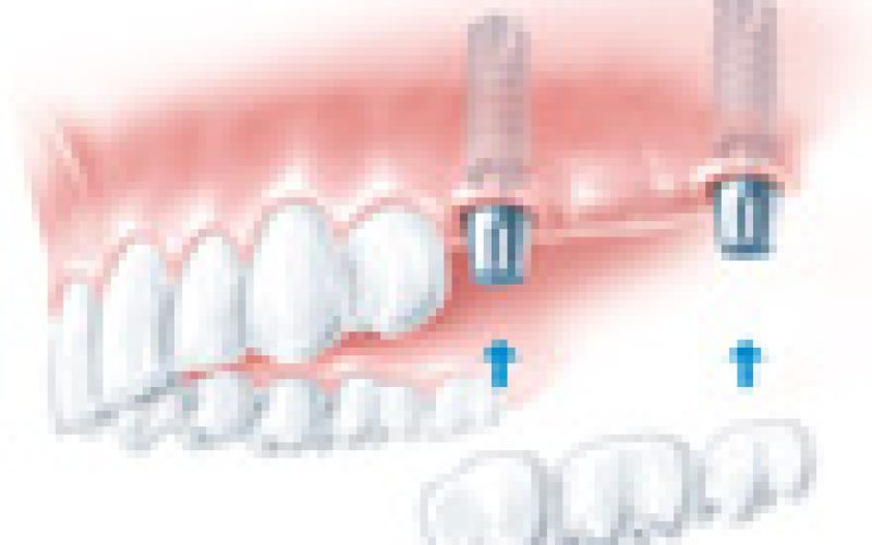 festsitzende_implantatbruecke