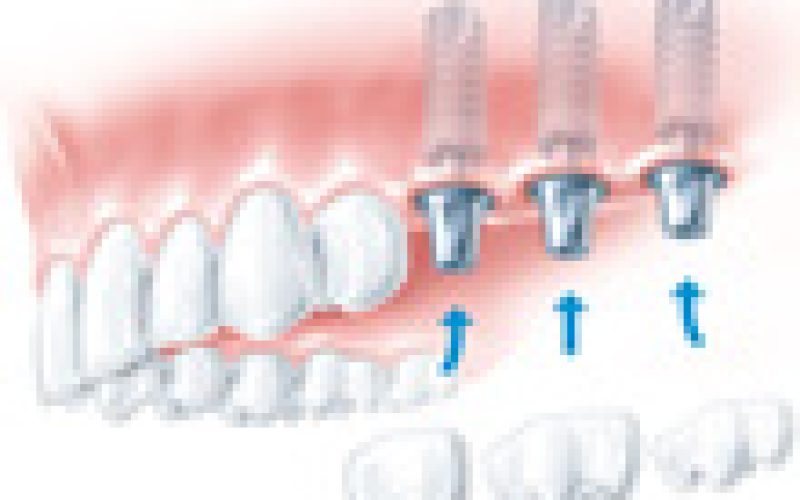 festsitzende_implantatkronen