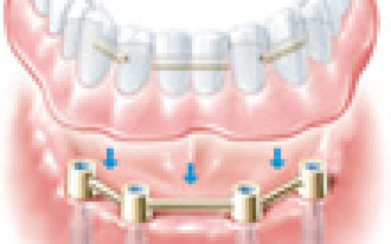 festsitzende_steggetragene_prothese