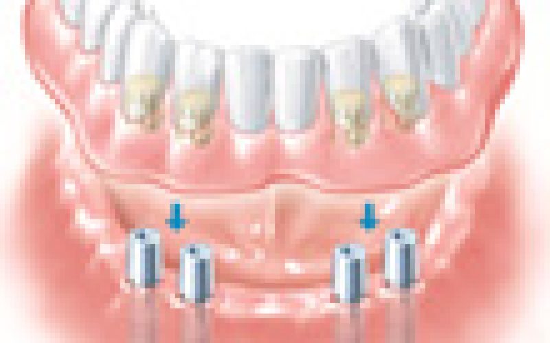 festsitzende_teleskopgetragene_prothese