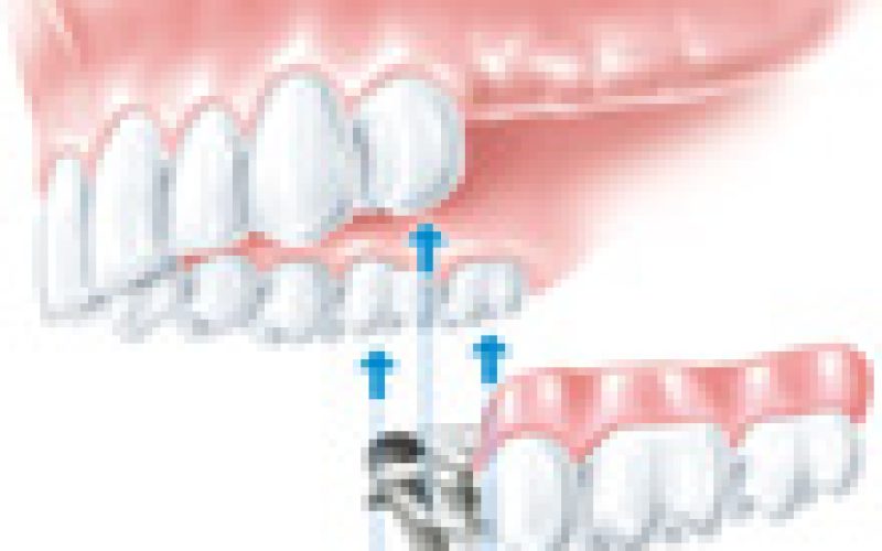 herausnehmbare_metallgetragene