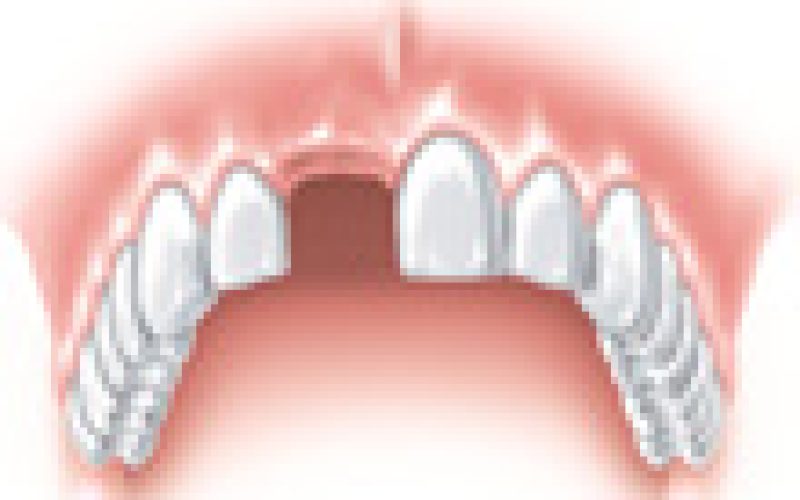 implantate_moeglichkeiten